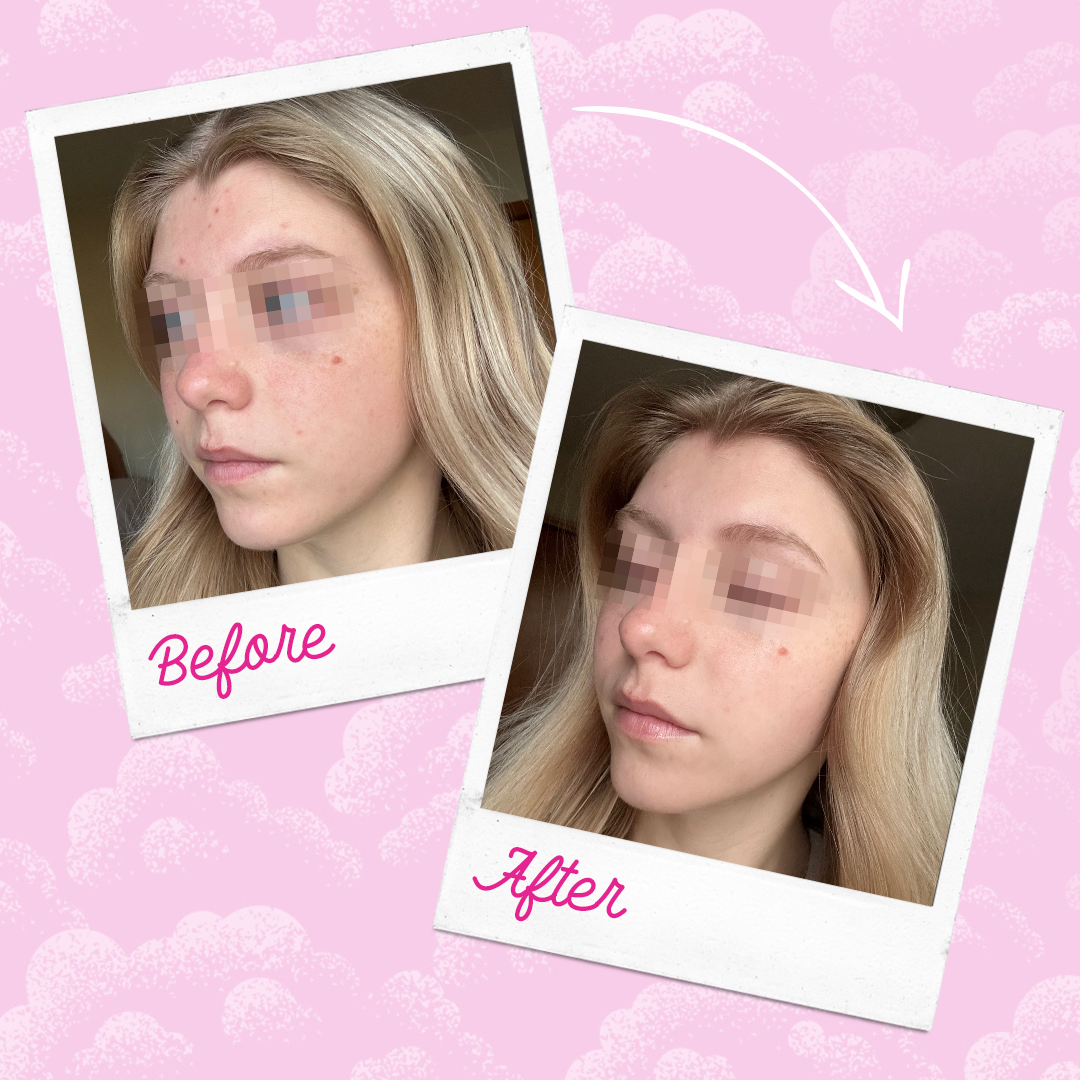 The Original MakeUp Eraser - Silver Infused MakeUp Eraser PRO | Acne Prone Skin