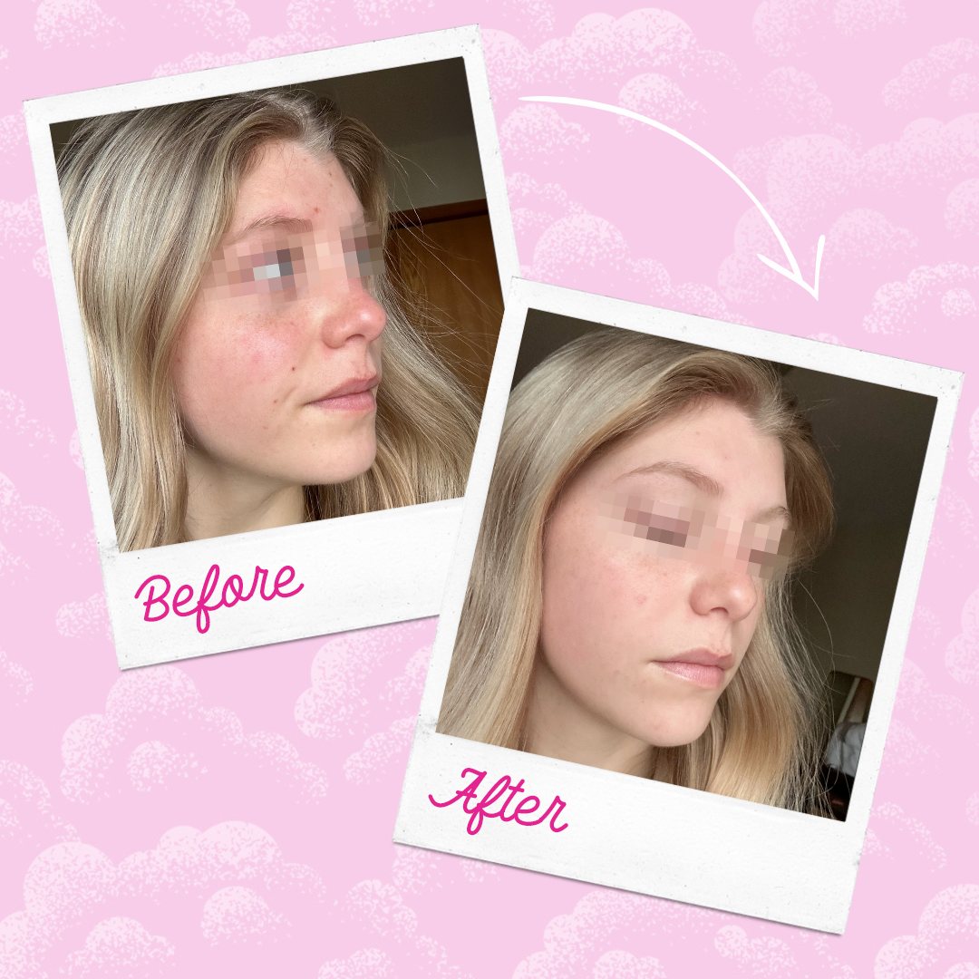 The Original MakeUp Eraser - Silver Infused MakeUp Eraser PRO | Acne Prone Skin